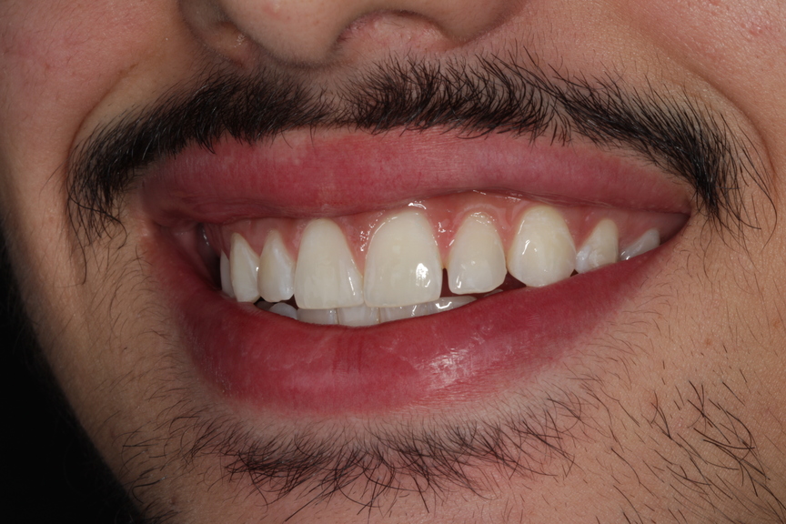 Clareamento dental