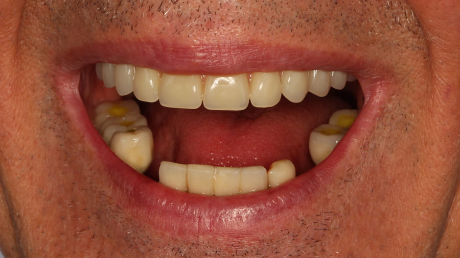 Invisalign  Multiodonto